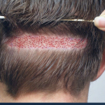 بهترین روش کاشت مو در سال 2025