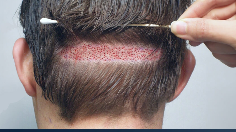 بهترین روش کاشت مو در سال 2025