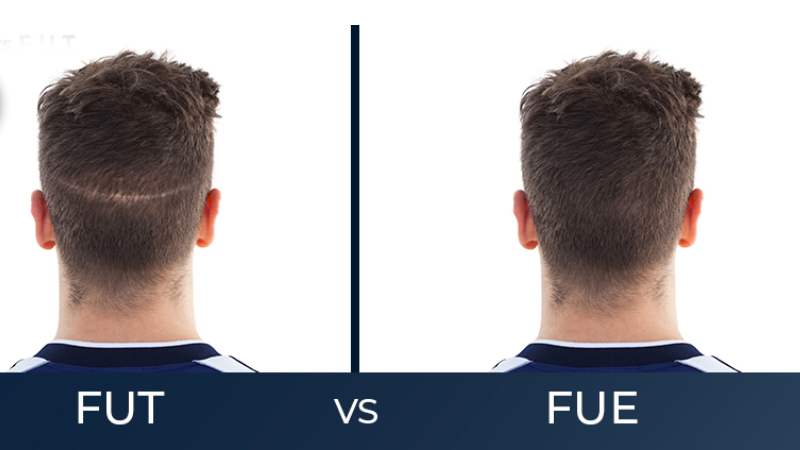 بهترین روش کاشت مو در سال 2025